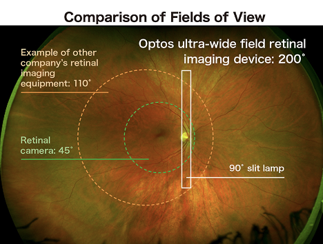 optomap retinal exam